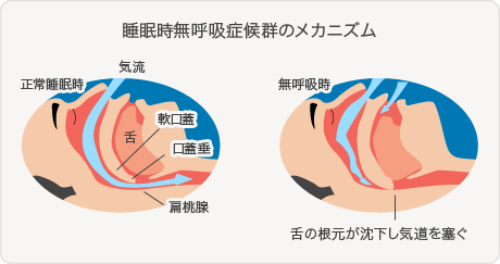 睡眠時無呼吸症候群とは？